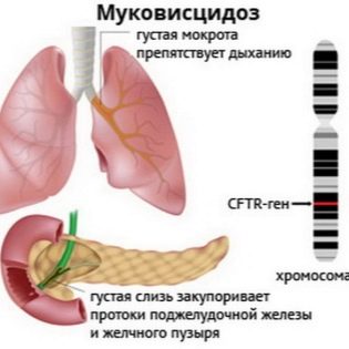 Флуімуціл – антибіотик ІТ: інструкція по застосуванню, ціна та відгуки. Як розводити для інгаляцій