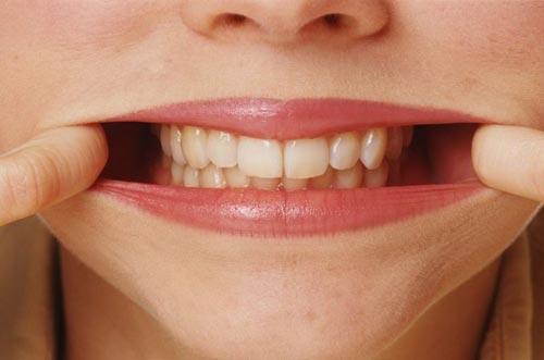 Флюс на десні симптоми: лікування в домашніх умовах Флюс на десні симптоми: лікування в домашніх умовах