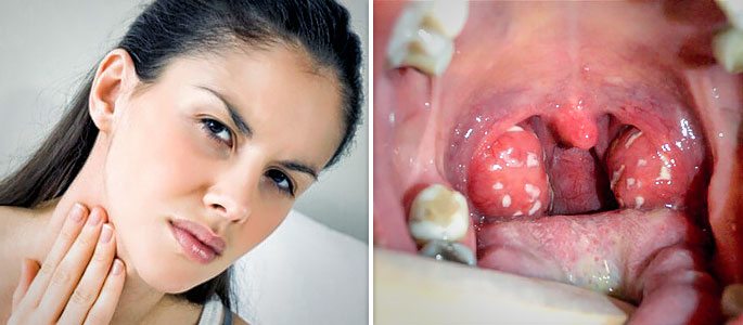 фолікулярна Ангіна без температури як лікувати