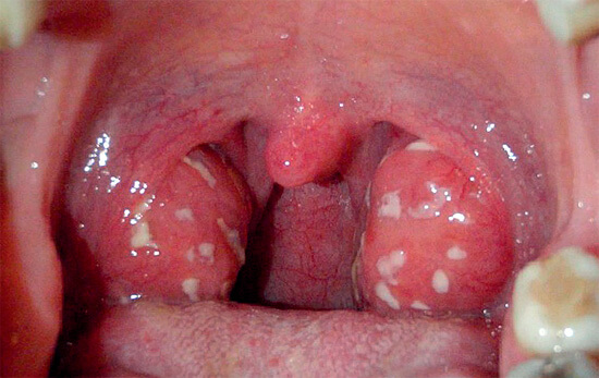 фолікулярна Ангіна без температури як лікувати