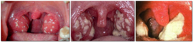 фолікулярна Ангіна без температури як лікувати