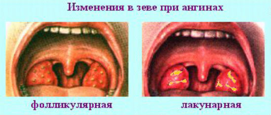 Фолікулярна ангіна: чим небезпечне це захворювання і як його розпізнати?