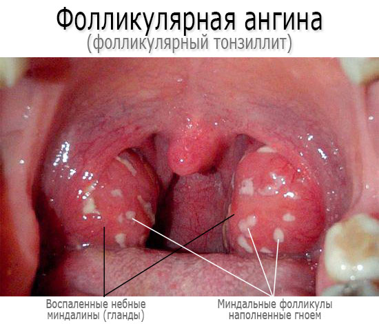 Фолікулярна ангіна у дітей і дорослих симптоми лікування причини