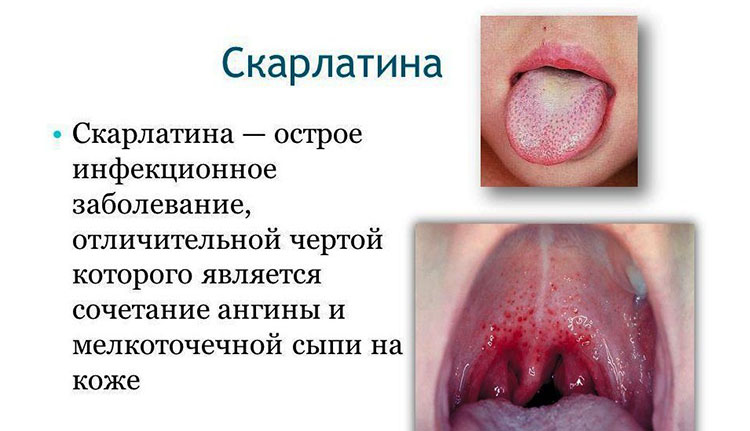 Фолікулярна ангіна у дітей: як лікувати фолікулярний тонзиліт у дитини