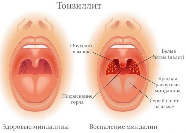 Фолікулярна ангіна у дорослих – симптоми, ускладнення, лікування і антибіотики при фолікулярній ангіні