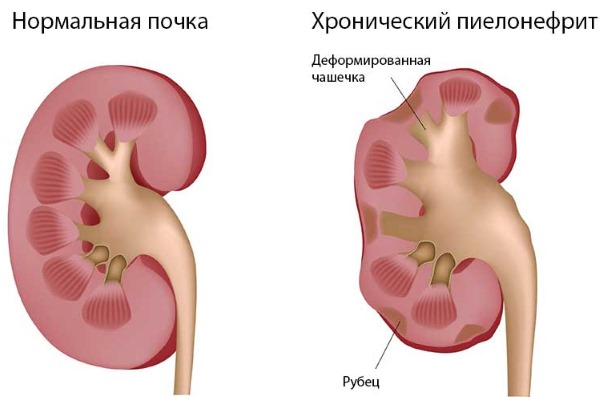 Фолікулярна ангіна у дорослих – симптоми, ускладнення, лікування і антибіотики при фолікулярній ангіні