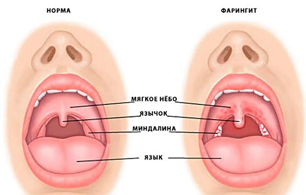 Фолікулярний фарингіт у дітей
