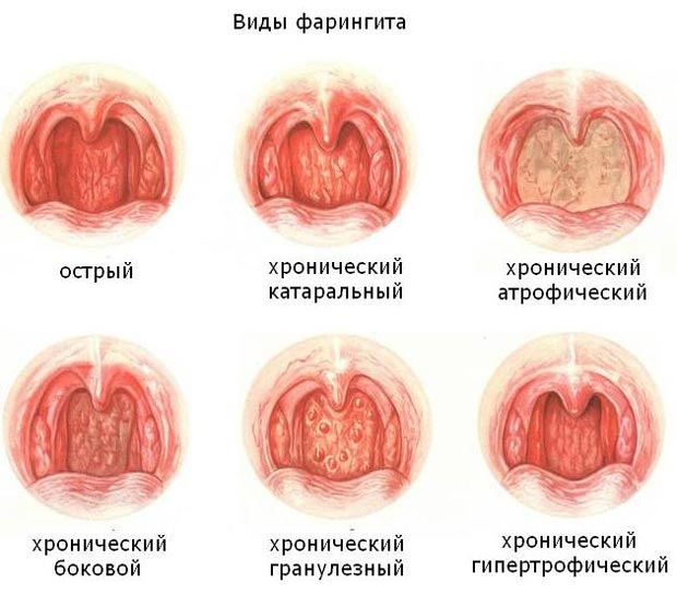Фолікулярний фарингіт у дітей