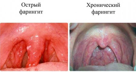 Фолікулярний фарингіт у дітей