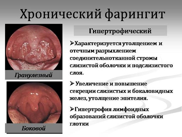 Фолікулярний фарингіт у дітей