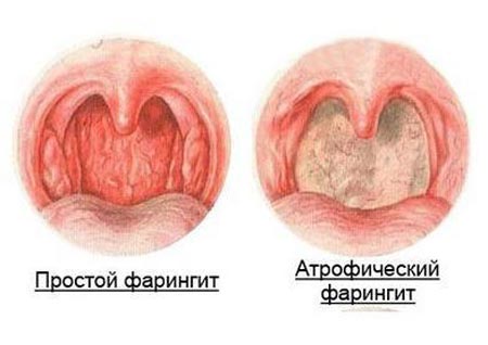 Фолікулярний фарингіт у дітей