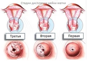 Фонові захворювання шийки матки