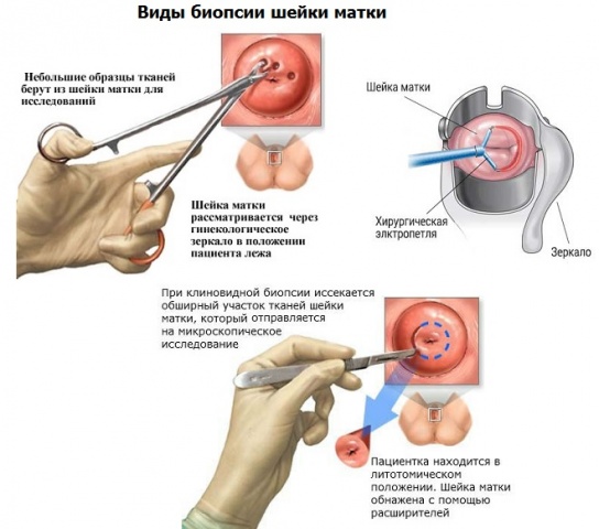 Фонові захворювання шийки матки