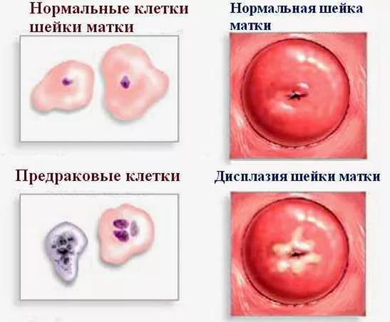 Фонові захворювання шийки матки