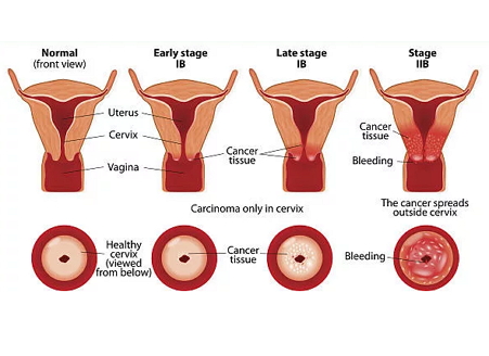 Фонові захворювання шийки матки