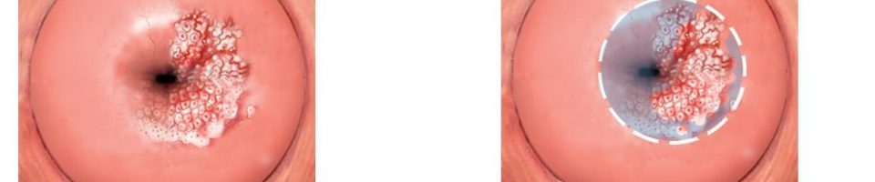 Фонові захворювання шийки матки