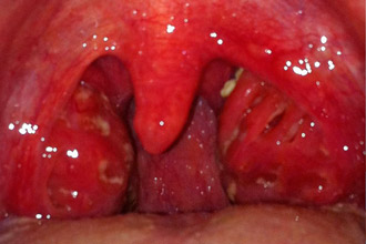 Форми бактеріального фарингіту і методи їх лікування Форми бактеріального фарингіту і методи їх лікування