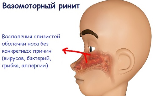 Форми вазомоторного риніту його симптоми і лікування у дорослих