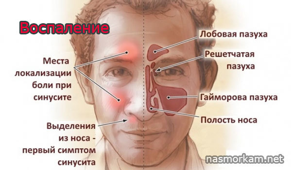 Фронтит і гайморит відмінність між хворобами