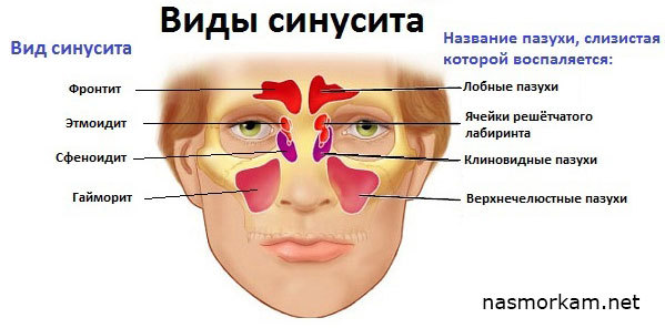 Фронтит і гайморит відмінність між хворобами