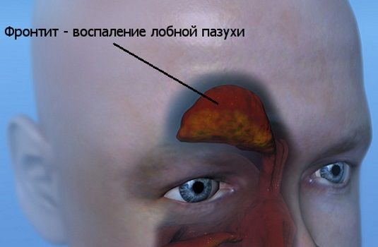 Фронтит – гострий і хронічний, діагностика та лікування