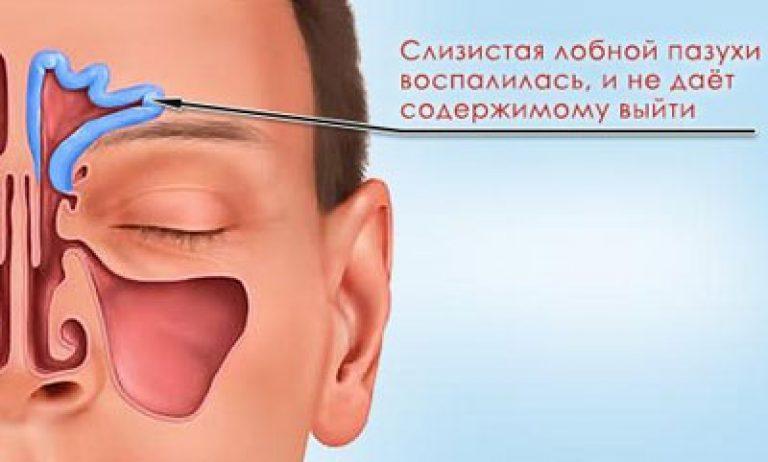 Фронтит симптоми і лікування. Що потрібно знати про хронічному фронтиті? Причини появи фронтиту