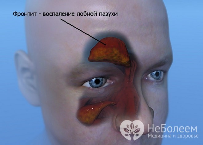 Фронтит: симптоми, види та лікування фронтита у дорослих