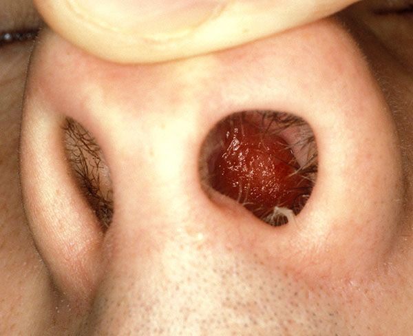 Фурункул на носі причини симптоми, діагностика та лікування