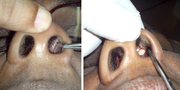 Фурункул на носі причини симптоми, діагностика та лікування