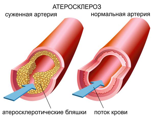 Гімнастика Шишонина для шиї при шийному остеохондрозі