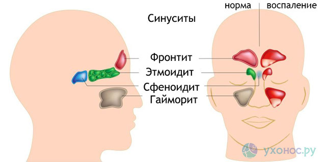 Гіперпластичний гайморит одна з форм хронічного синуситу
