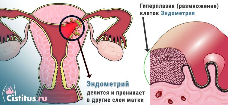 Гіперплазія ендометрія в менопаузі: норма при клімаксі