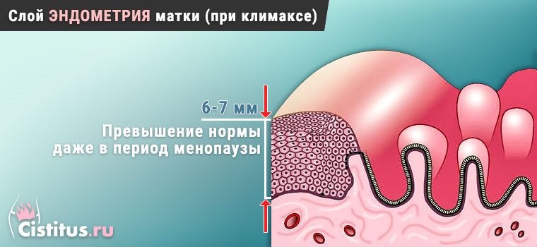 Гіперплазія ендометрія в менопаузі: норма при клімаксі