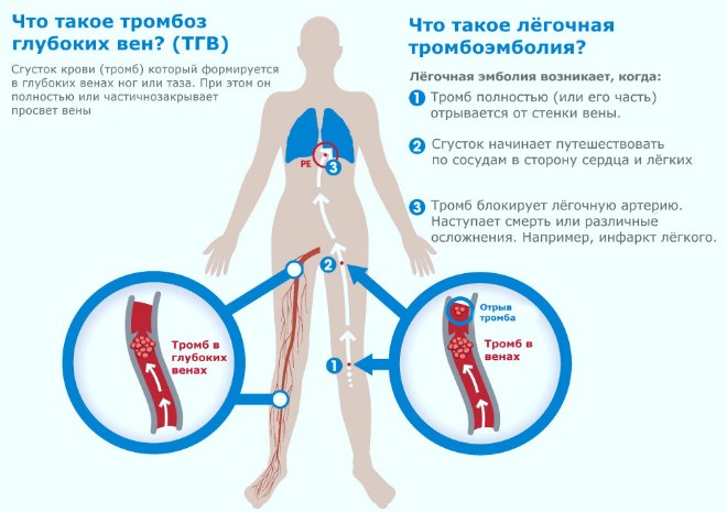 Гіпертонічна хвороба 3 стадії 3 ступеня ризик 4: що це таке