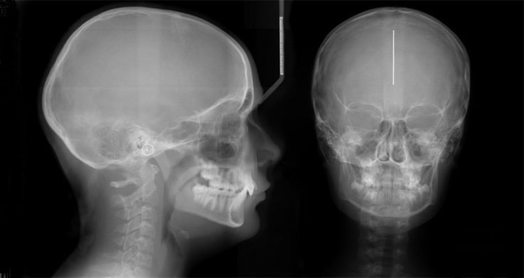 Гайморит на рентгенівському знімку розшифровка рентгенограми