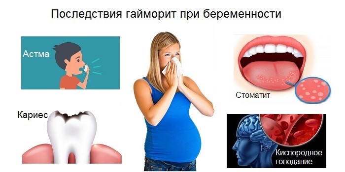 Гайморит при вагітності симптоми і лікування