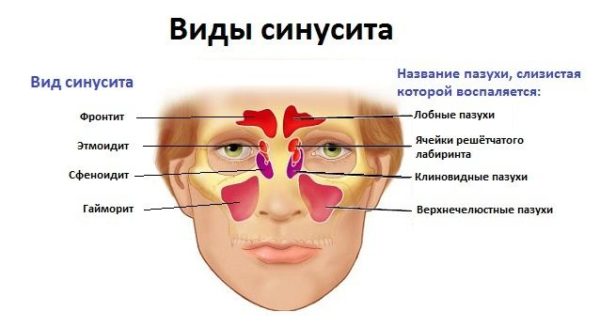 Гемисинусит – симптоми і лікування хронічного, гострого гемисинусита