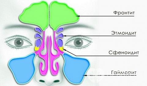Гемисинусит – симптоми і лікування хронічного, гострого гемисинусита