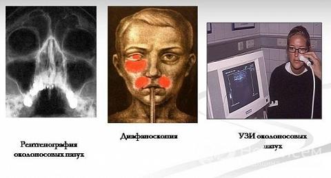 Гемисинусит – симптоми і лікування хронічного, гострого гемисинусита