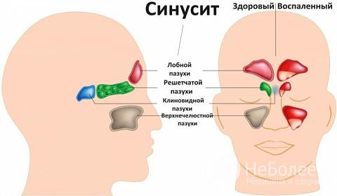 Гемисинусит – симптоми і лікування хронічного, гострого гемисинусита