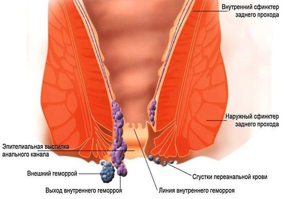 Гемороїдальні вузли лікування народними засобами