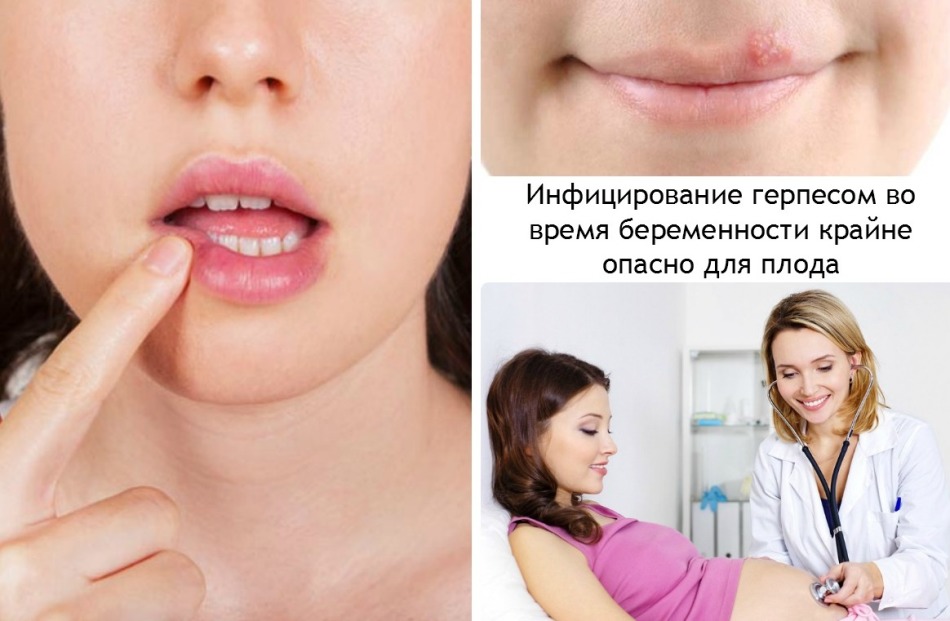 Герпес на губах під час вагітності: небезпека, наслідки, лікування. Причини герпесу на губах у 1, 2 і 3 триместрі вагітності
