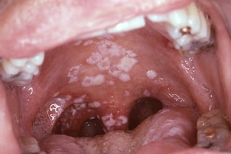 Герпес у горлі основні симптоми вірусної інфекції