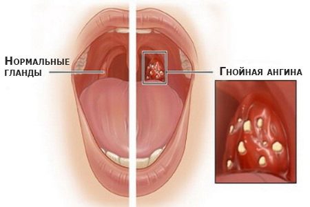 Гнійна ангіна що впливає на ймовірність захворювання і чого можна не побоюватися