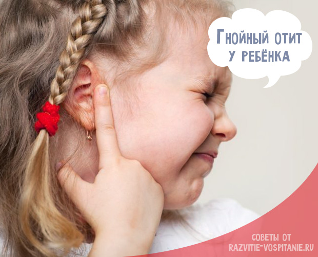 Гнійний отит у дитини – симптоми і лікування дітей 2019
