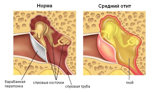 Гнійний отит у дорослих: лікування в домашніх умовах Гнійний отит у дорослих: лікування в домашніх умовах