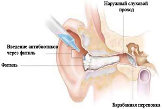 Гноїться вухо всередині Чим лікувати. Як вилікувати гнійний отит будинку? Інфекційне ускладнення від інфекційних респіраторних захворювань