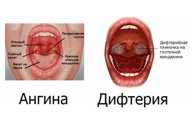 Головний біль і біль у горлі: можливі причини недуг
