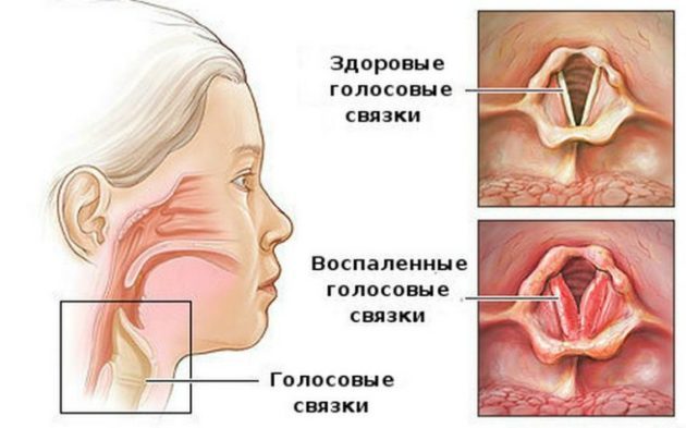 Головний біль і біль у горлі: можливі причини недуг