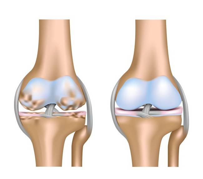 Гонартроз колінного суглоба лікування народними засобами відгуки